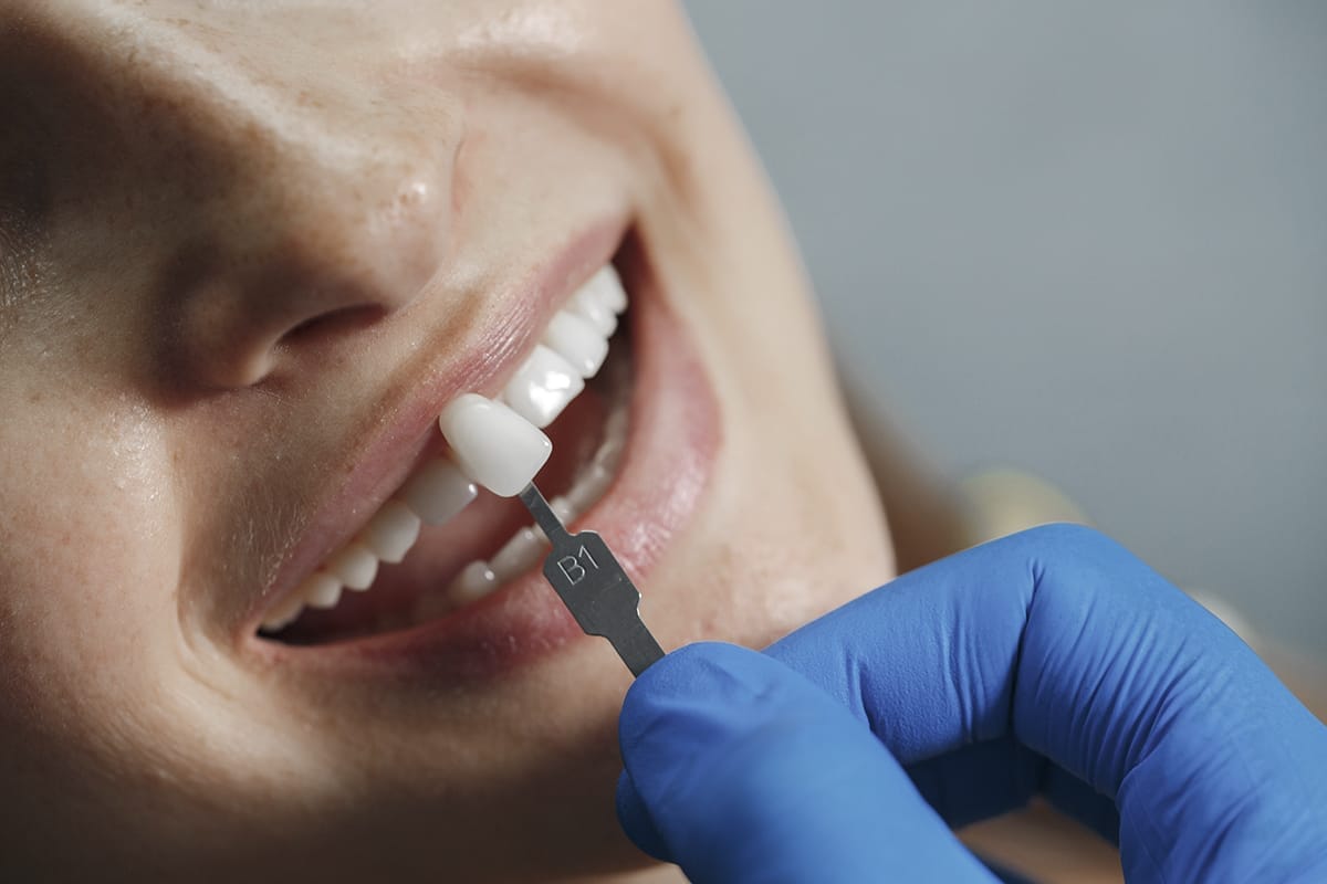 cuidado-mantenimiento-carillas-dentales Cuidado y mantenimiento de carillas dentales