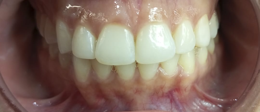 Blanqueamiento dental antes