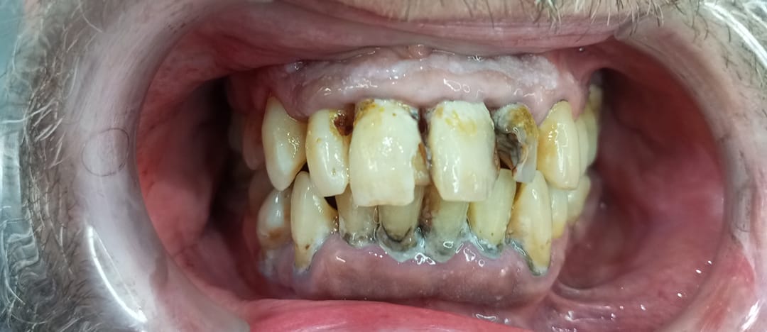 Caso de saneamiento y reconstrucciones antes